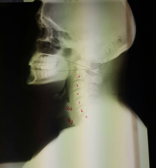 X-Rays - Before Treatment